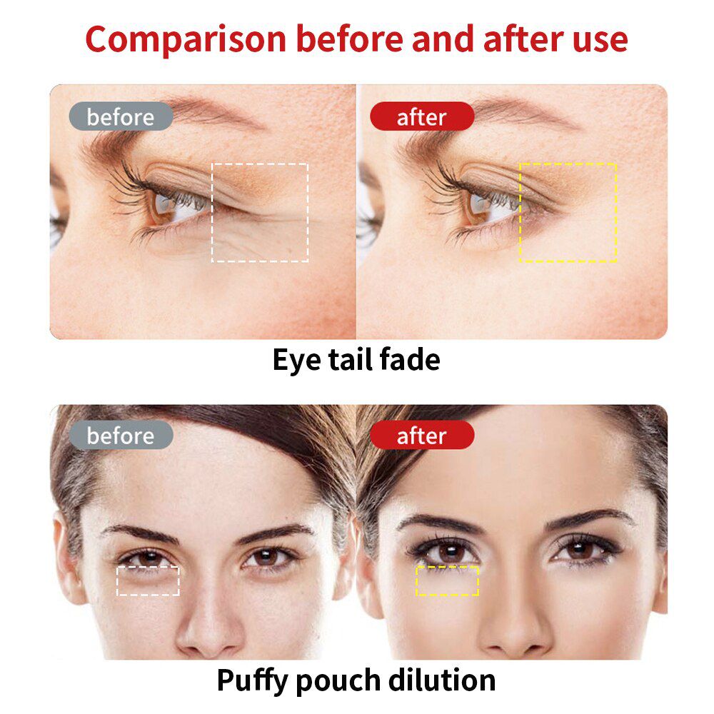 New Eye Messager RF&EMS Radio Mesotherapy Electroporation Frequency LED Photon Face Skin Rejuvenation Remover Wrinkle Beauty Pen