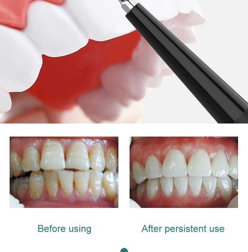 Electric Ultrasonic Sonic Dental Scale