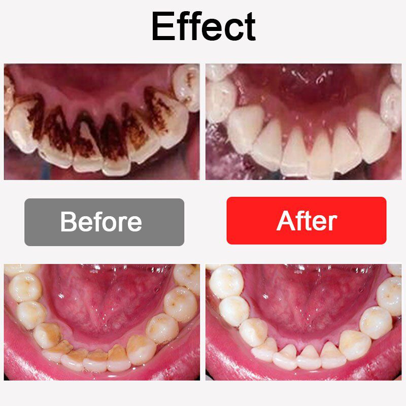 Ultrasonic Dental Scale